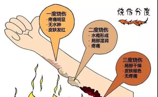 当你遇到烧烫伤时应该怎么办？