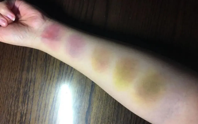 身上经常无缘无故出现淤青?小心背后有大危险!