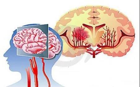 脑出血前的十大救命信号七条预防举措要牢记!