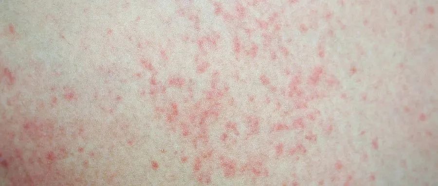 踏春出游后出现发热、皮疹,小心是这种急性传染病!