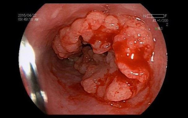 这些饮食“习惯”会害了你和家人，再这样吃可能会被这种癌“盯上”！
