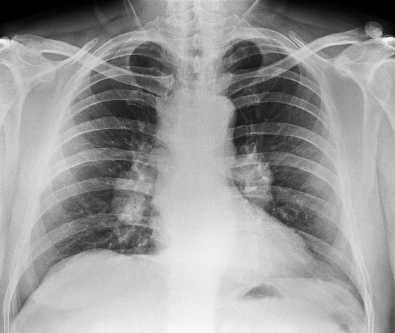 为何近两年查出肺结节的人这么多?