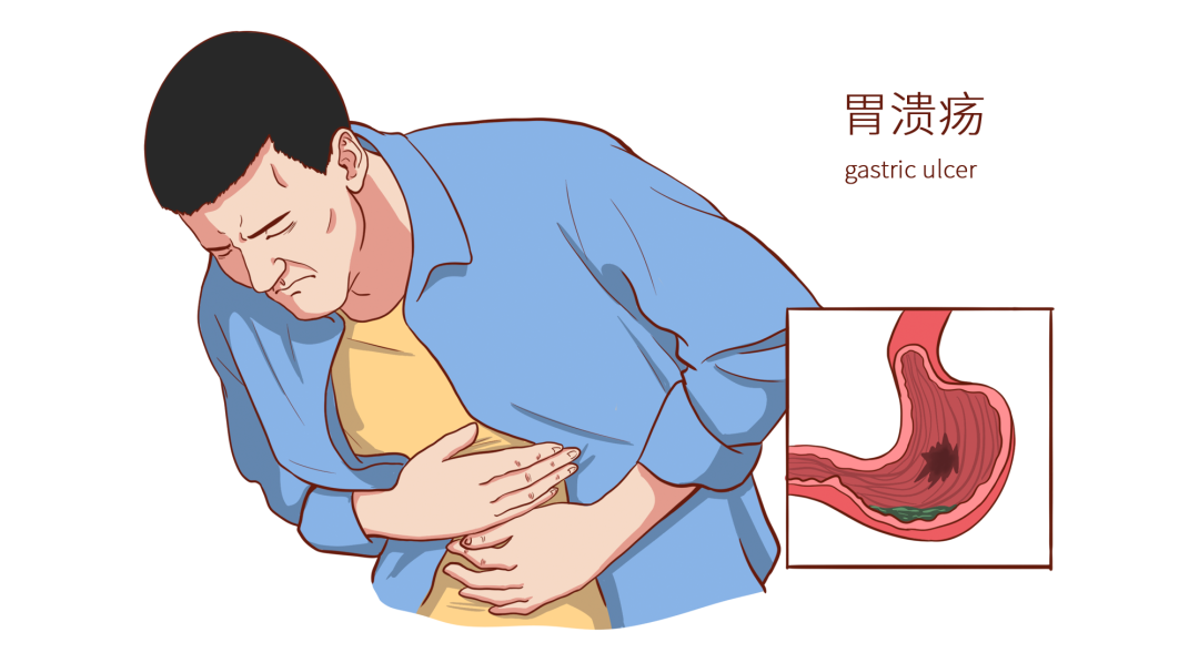 警惕!中青年人经常忍而不治的胃痛可能就是这种病