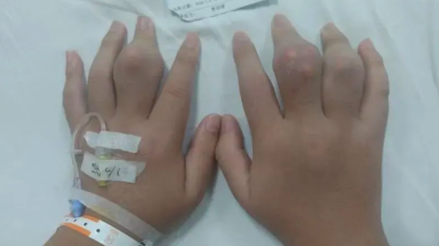 又到高发季!没有症状、突然发作,知名男星曾因此坐上轮椅