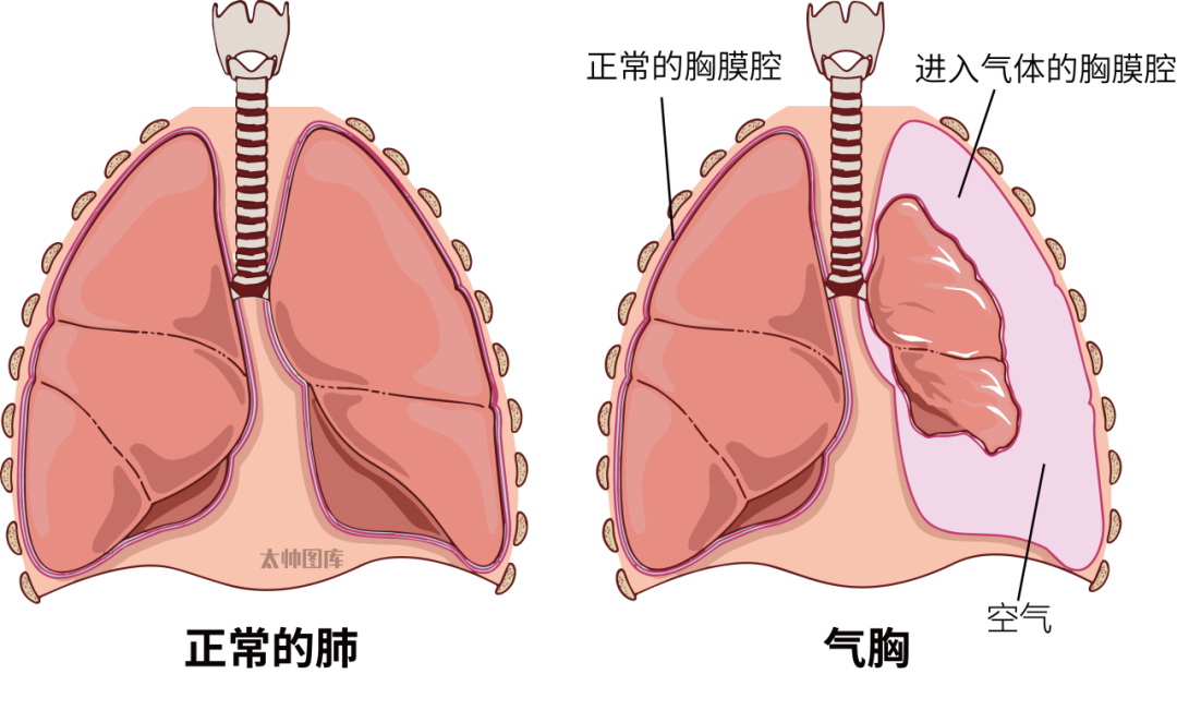 一口气做了20个，肺缩到仅剩三分之一！这种行为快停下