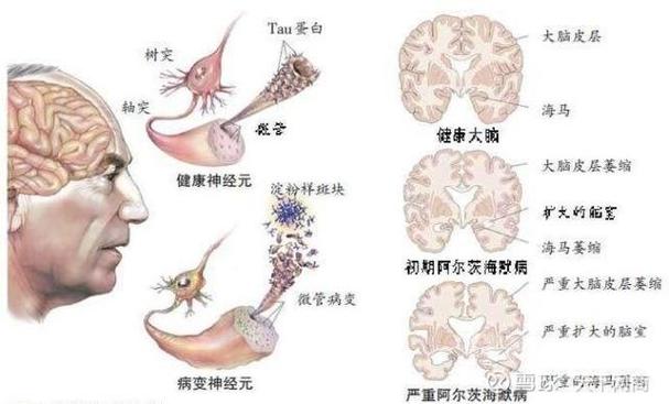 海南应用国内首款阿尔茨海默病检测试剂，免费检测名额→