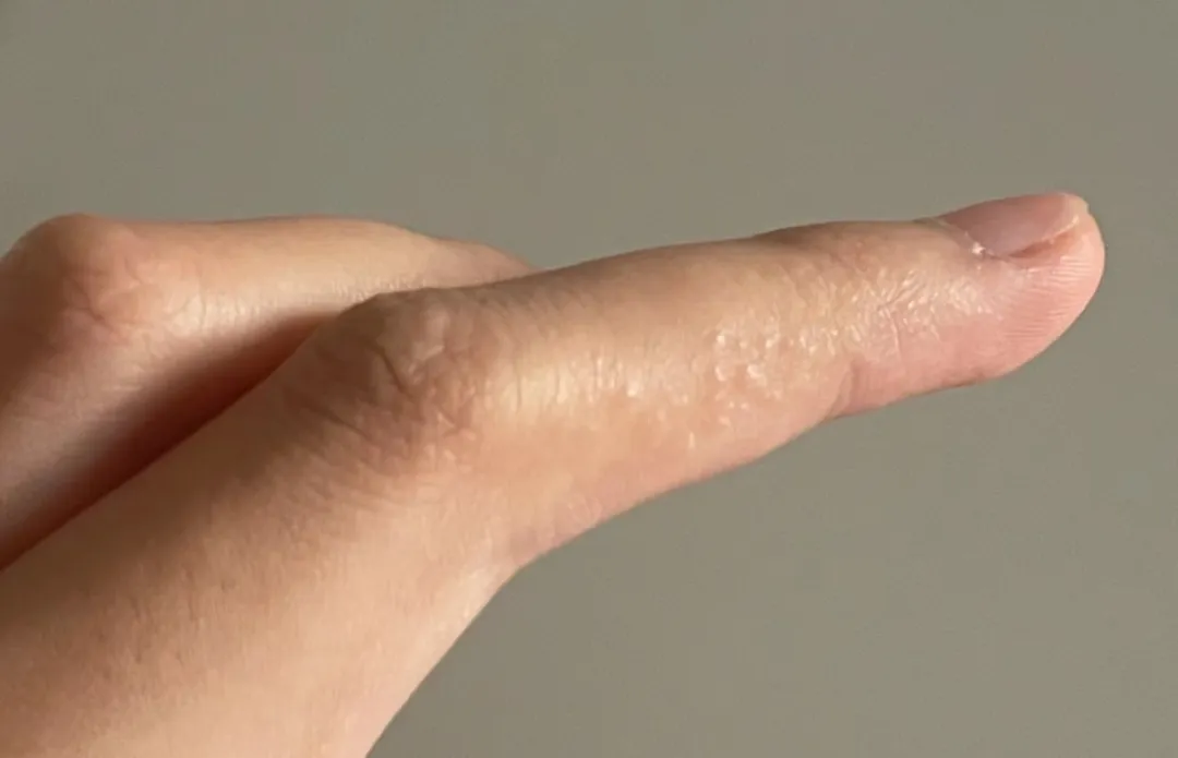 为什么一到夏天，手上就长透明小水泡？