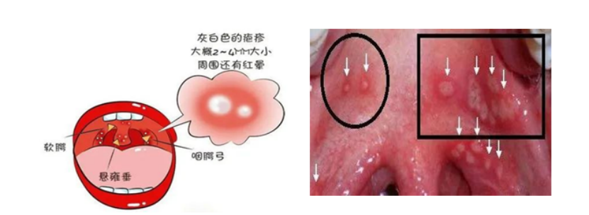 家长注意!得了这种病,孩子高烧、疼得水都喝不下,一定要学会预防