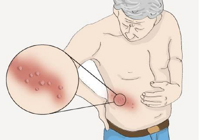 带状疱疹发作,可能疼痛难忍!过了这个年龄的人要留意