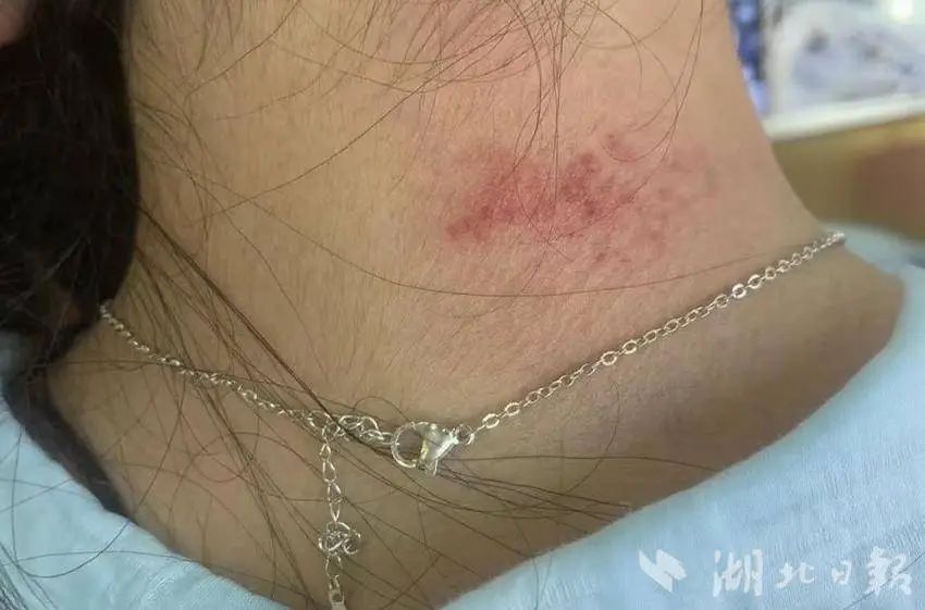 高毒性重金属超标!夏季高发!医生提醒:不要长时间佩戴