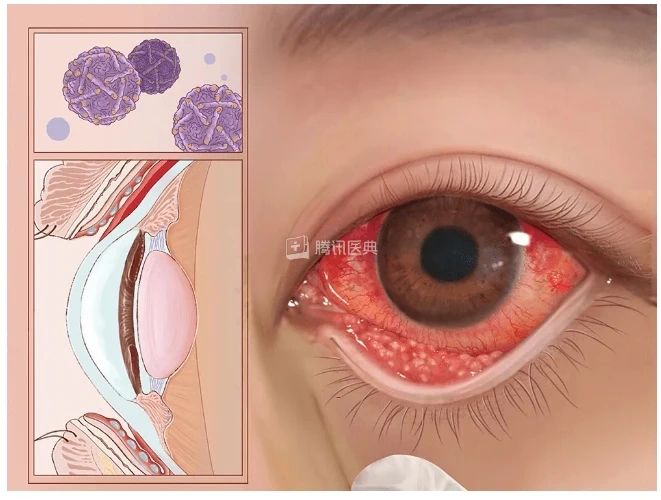 一人中招,传染一群!开学了,这种病进入高发期