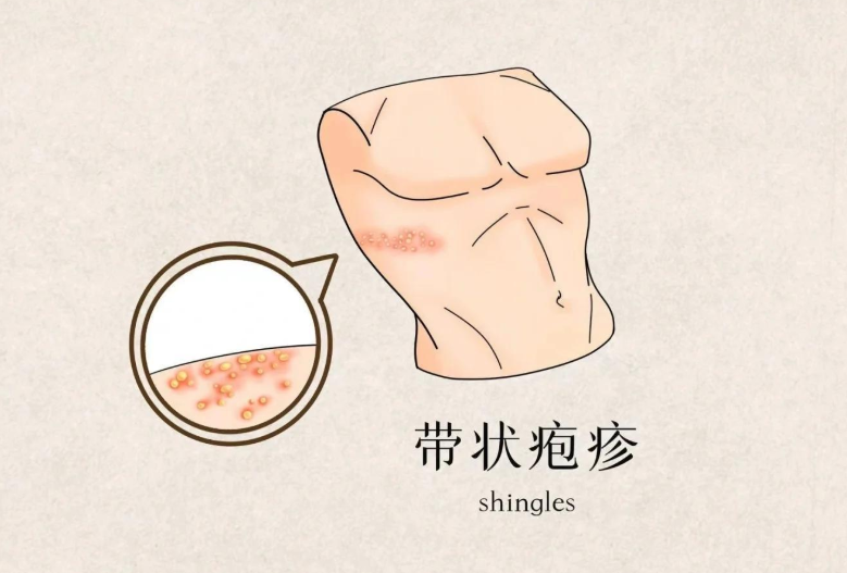 巨疼!会传染!过度劳累、熬夜或引起这种病