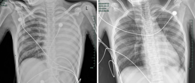 发热仅1天,肺全白了!这种病极度危险,千万别当普通感冒