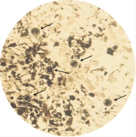 螃蟹不能这样吃!有人因此肺、肝等多个器官都坏了!